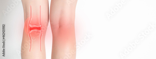 Redness and pain in the knee joints in a girl. White background, treatment of arthrosis and arthritis. Copy space for text