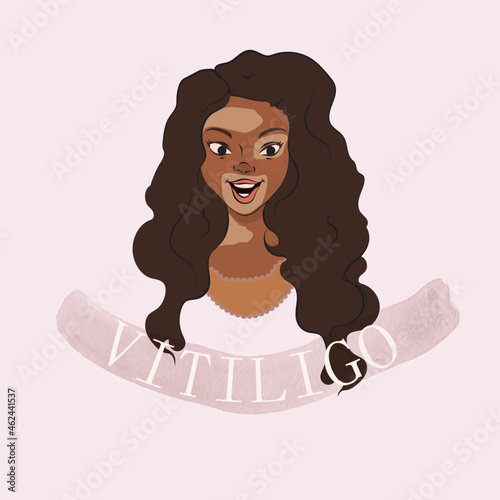 Black woman with vitiligo. World vitiligo day. Body positive and selflove.