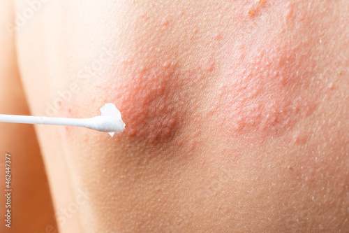 cotton swab treatment of skin rash. Shingles, varicella-zoster virus. skin rash and blisters on body. Skin infected Herpes zoster virus. Herpes Virus on body. urticaria rash. atopic dermatitis photo