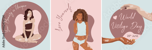 Your Beauty is unique. Love yourself. Young european and african woman with Vitiligo. World Vitiligo Day 25th June. Two hands with Vitiligo desease around world.