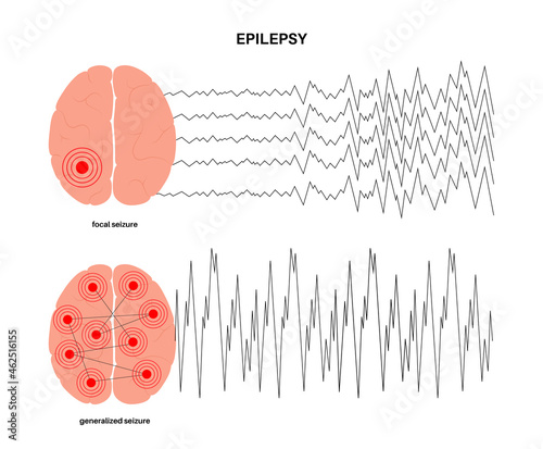 epilepsy seizure concept