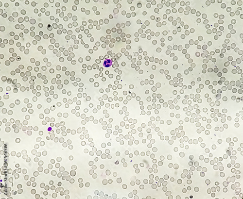 Acute leucopenia and thrombocytopenia. close up micrograph photo