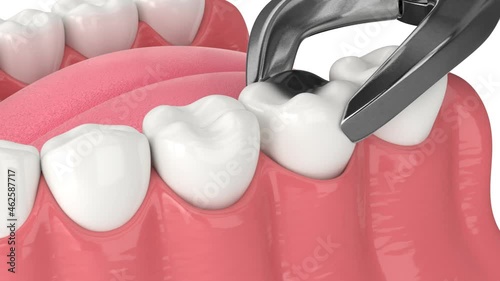 Jaw with rebuilding bone and tooth procedure