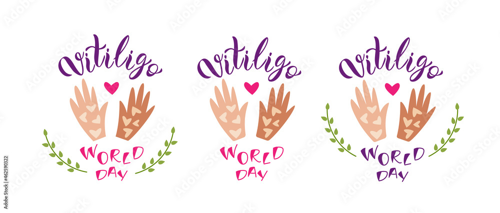 Set of three Vitiligo World Day lettering compositions with hands. Vector isolated colorful illustration. Set of three Vitiligo World Day lettering compositions with hands. Vector isolated colorful illustration.