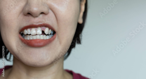 girl's teeth, missing teeth, bad dental health