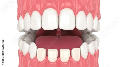 Human jaw with dental veneers installation