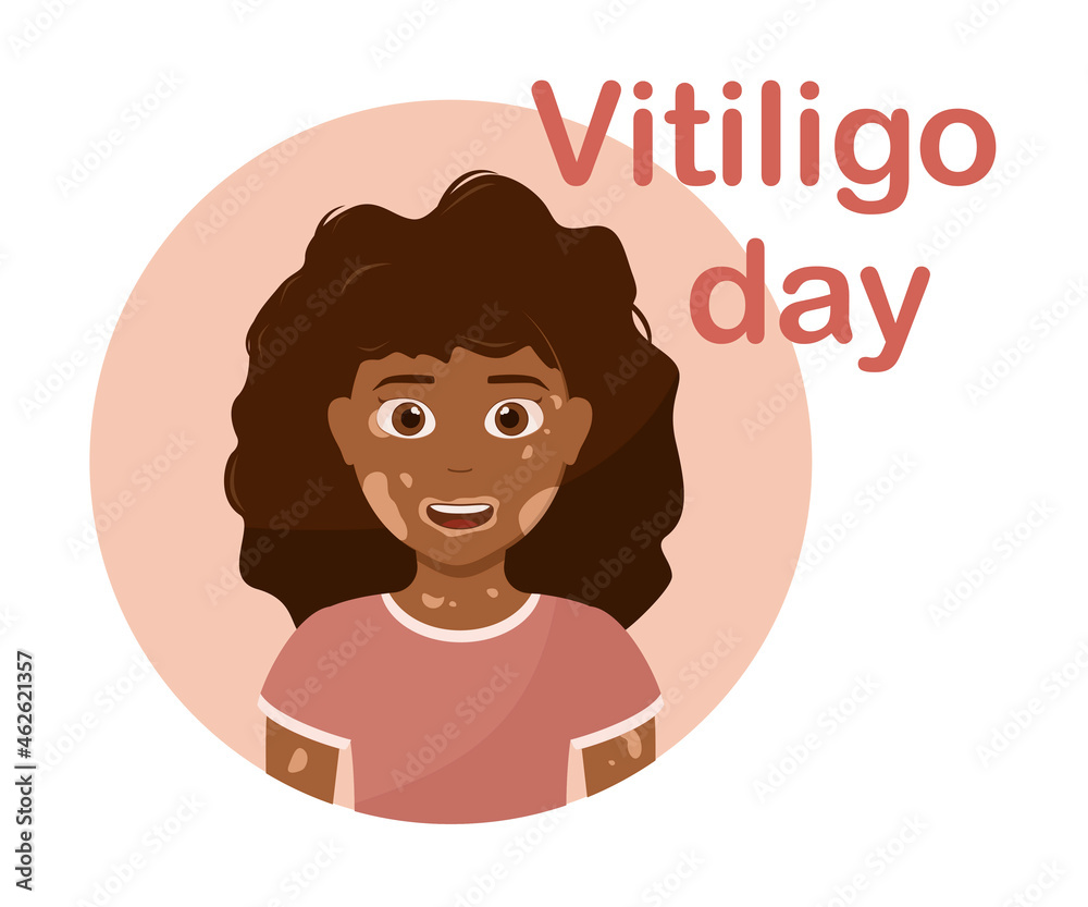 Vitiligo day. Little girl with vitiligo. Skin disease. Body care Pigment problem. Happy child. Vector illustration Vitiligo day. Little girl with vitiligo. Skin disease. Body care Pigment problem. Happy child. Vector illustration