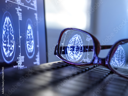 Brain scan results reflecting in protective glasses lying on laptop keyboard
