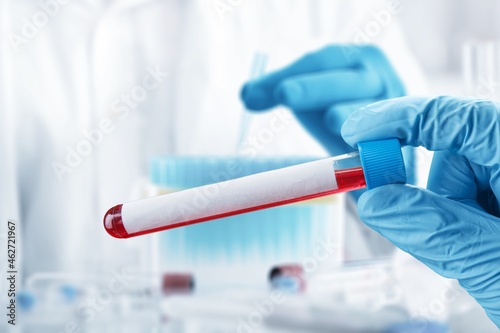 Doctor testing with blood test tube from patient infected with Coronavirus variant.