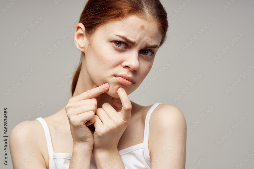 pretty woman with pimples on the face hygiene light background pretty woman with pimples on the face hygiene light background