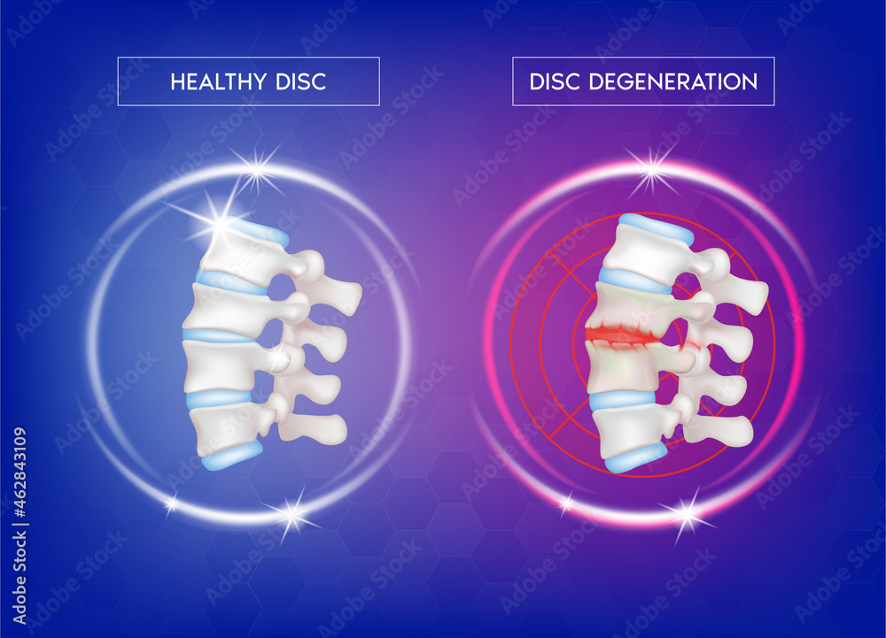 Spine disease, normal backbone, degenerative disc and herniated disc ...