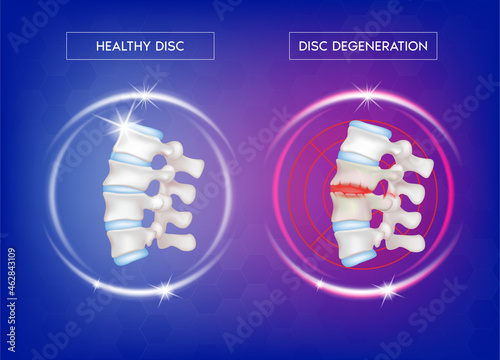 Spine disease, normal backbone, degenerative disc and herniated disc. Skeleton x ray scan concept. Human vertebrae anatomy medical flat. 3D Vector illustration