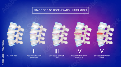 Stage of disc degeneration herniation. Spine disease, normal backbone, degenerative disc and herniated disc. Skeleton x ray scan concept. Human vertebrae anatomy medical. 3D Vector illustration photo