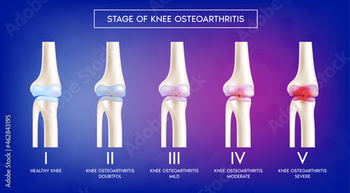 Stage of knee osteoarthritis, Healthy knee, normal bones. Skeleton x ray scan concept. Human vertebrae anatomy medical flat. 3D Vector illustration