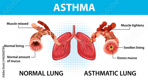 Bronchial Asthma diagram with normal lung and asthmatic lung