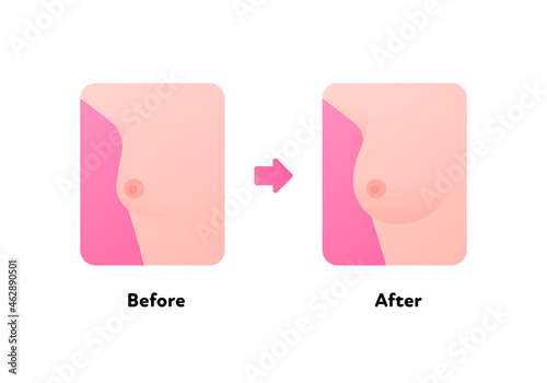 Female human breast enlargement surgery infographic chart. Vector flat medical illustration. Before and after stages isolated on white background.