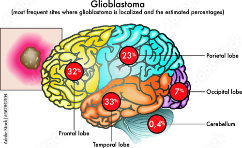 Medical illustration of most frequent sites where glioblastoma is localized in the brain and the estimated percentages.