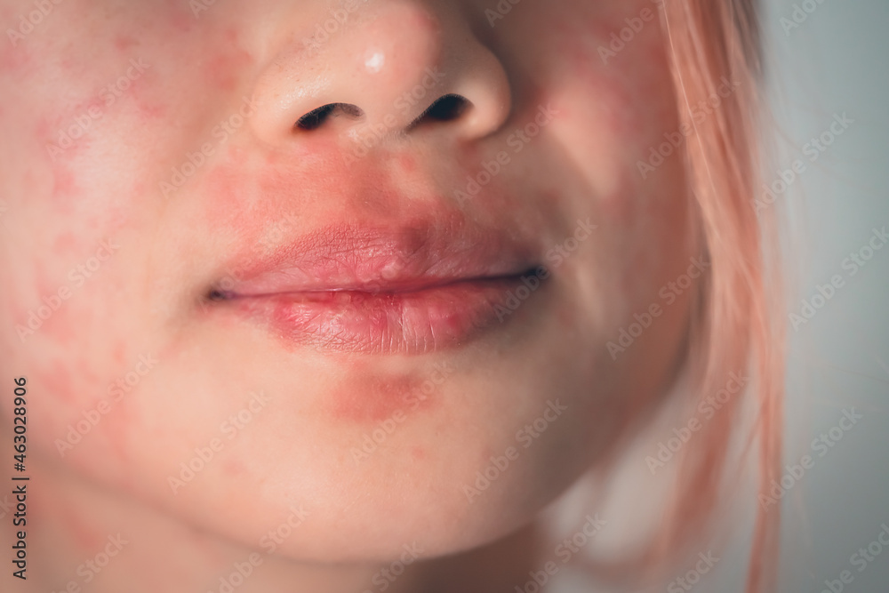 Asian woman suffering from Skin allergy from Cosmetic and Make up making  her skin all over the face and mouth red itchy and painful. Photos | Adobe  Stock