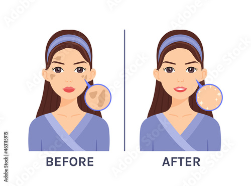 Cartoon Beautiful Woman with Pigmented Spots on Face. Problem Skin. Skin Disease. Treatment. Before After. Happy Young Girl with a Clean Health Face. Illustration for Beauty and Medical Design. Vector