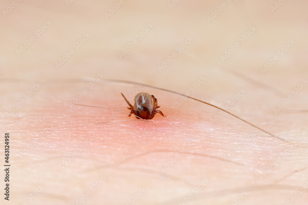 Sucking tick Macro photo on human skin. Ixodes ricinus. Bloated parasite bitten into pink irritated epidermis. Dangerous insect mite. Encephalitis, Erythema that may show Lyme disease infection. Sucking tick Macro photo on human skin. Ixodes ricinus. Bloated parasite bitten into pink irritated epidermis. Dangerous insect mite. Encephalitis, Erythema that may show Lyme disease infection.