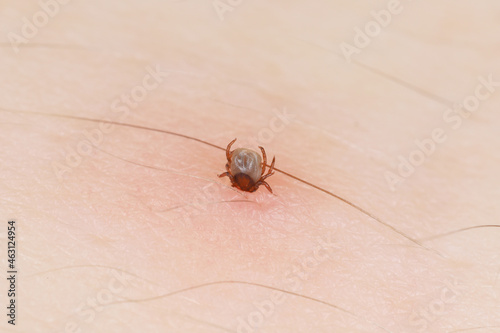 Sucking tick Macro photo on human skin. Ixodes ricinus. Bloated parasite bitten into pink irritated epidermis. Dangerous insect mite. Encephalitis, Erythema that may show Lyme disease infection.
