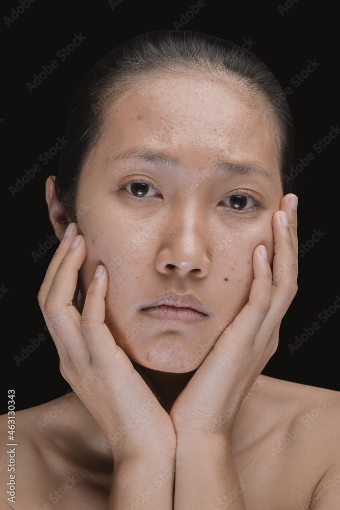 A young woman is worried about the problem of acne on her face.