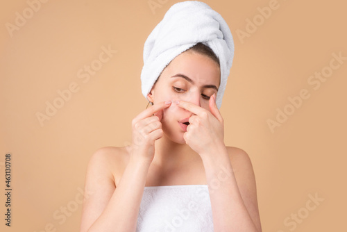 Woman squeezing pimples on her face. Acne blemish spots skin on young woman. Spot scar acne, freckles, and melasma pigmentation skin facial treatment, problem skin concept.