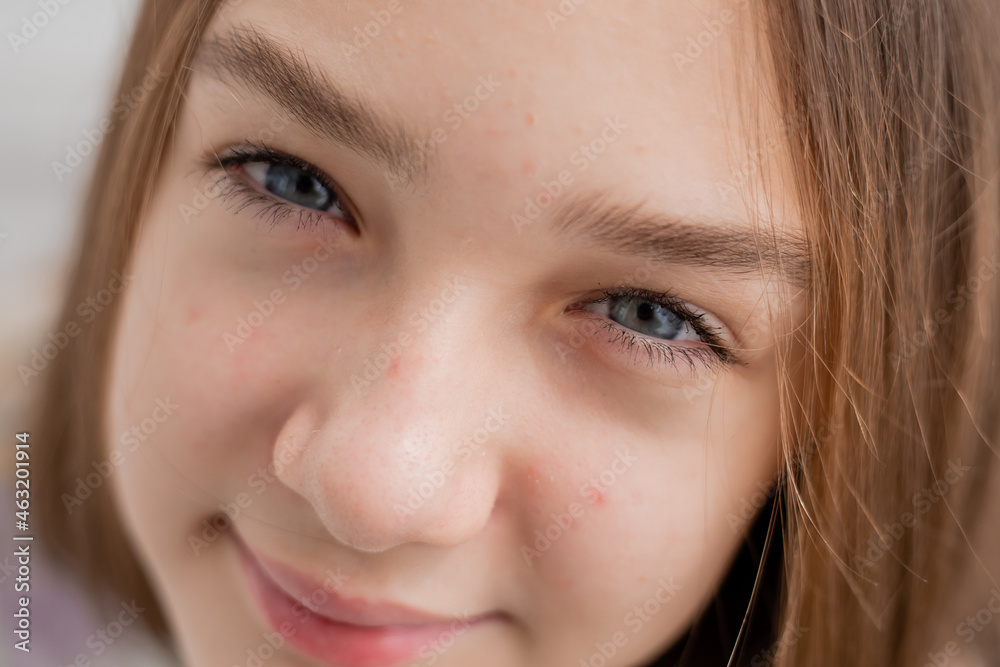 Face of a teenage girl in close up. Teen with problematic skin. Girl with a square hairstyle. Acne and scars. Natural portrait. No makeup and retouch. High quality photo Face of a teenage girl in close up. Teen with problematic skin. Girl with a square hairstyle. Acne and scars. Natural portrait. No makeup and retouch. High quality photo
