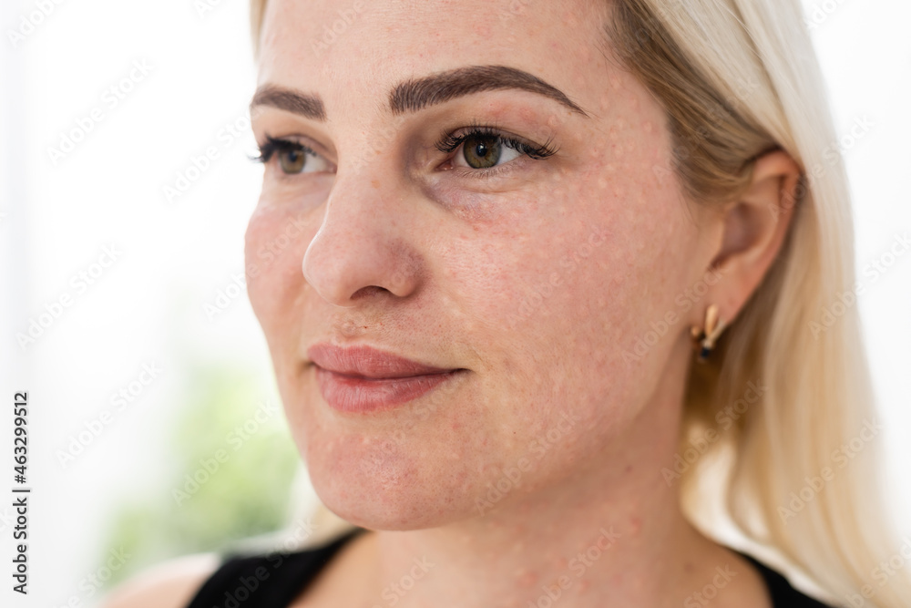 Fototapeta premium Real skin Biorevitalization on white background. Traces of biorevitalization injections on woman face. Biorevitalization needle marks Beauty treatment, real papules after hyaluronic injection.