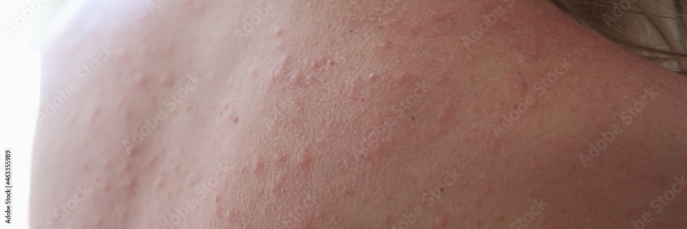 Woman injured back with rash and red sun spots Woman injured back with rash and red sun spots