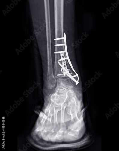  X-ray image of ankle joint showing surgical treatment by internal fixation with plate and screw. photo