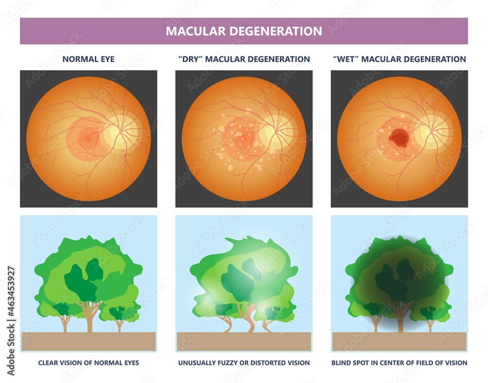 macular degeneration hemorrhage dry wet Age hole pucker edema eye ...