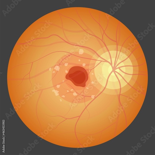 macular degeneration hemorrhage dry wet Age hole pucker edema eye vision loss AMD retina drusen blind spots Blood vessels leak blurry adult lose visual field exam treat contact lens myopia older tear