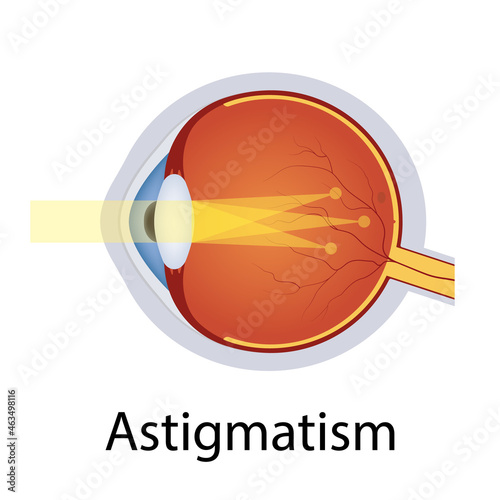 Astigmatism and Vision Disorders Illustration. Eyes Defect Concept. Detailed Anatomy Eyeball with Astigmatism Defect. Isolated Vector
