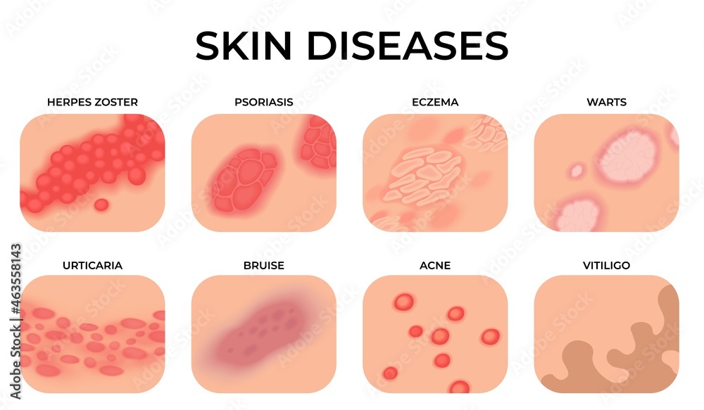 Skin disease. Different diseases, epidermis surface with eczema ...
