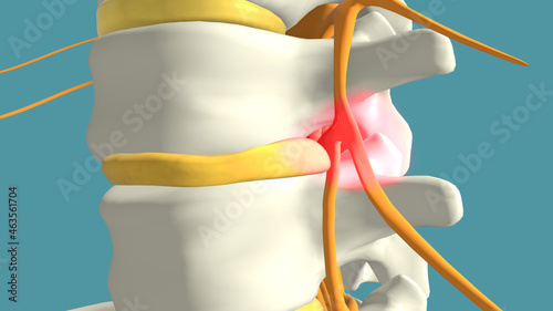 Close up to a prolapsed or slipped disc, spinal disc herniation, 3d illustration isolated on blue background photo