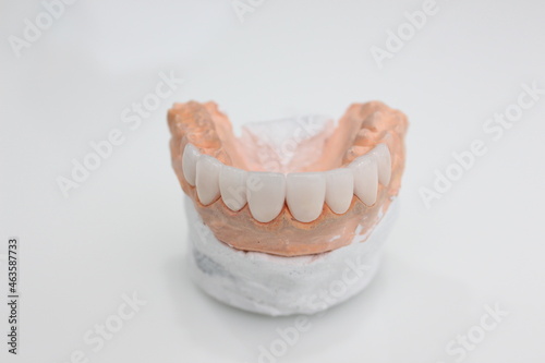 A dental bridge made of zirconia material that is made by a technician for the dentist to put on the patient.