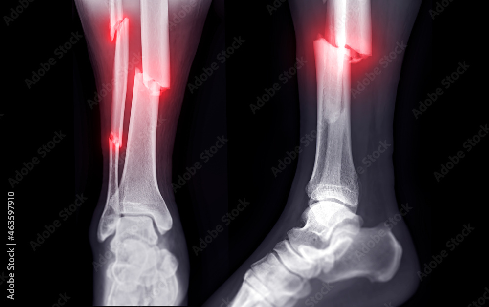 Xray image of ankle joint showing fracture tibia and fibula bone