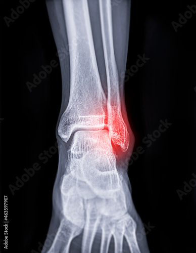 Fotografija X-ray image of ankle joint showing fracture of ankle joint..