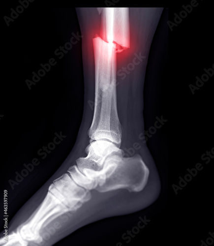 Canvas Print X-ray image of ankle joint showing fracture tibia and fibula bone