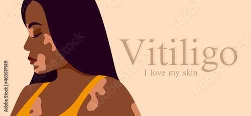 Vitiligo is a young dark-skinned woman with skin problems. Skin diseases. The concept of World Vitiligo Day. Different skin colors of female characters. For a blog, articles, banner, magazine. 