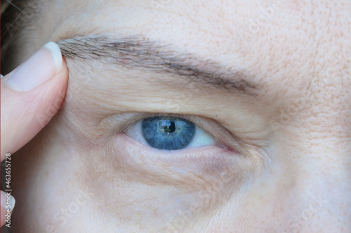 middle aged female's eye with drooping eyelid. Ptosis is a drooping of the upper eyelid, lazy eye. Cosmetology and facial concept, first wrinkles