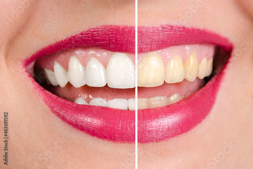 Before and after teeth whitening, closeup shot. Left half of image of beautiful white teeth and right half of yellow teeth 