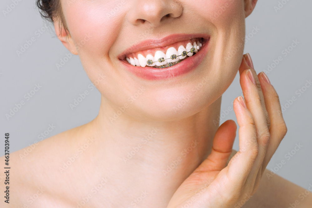 Obraz premium Orthodontic treatment. Dental care concept.Healthy smile close up. Closeup ceramic and metal brackets on teeth. Beautiful female smile with braces.