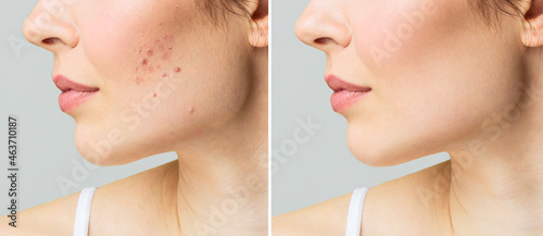 Young woman before and after acne treatment. Skin care concept.