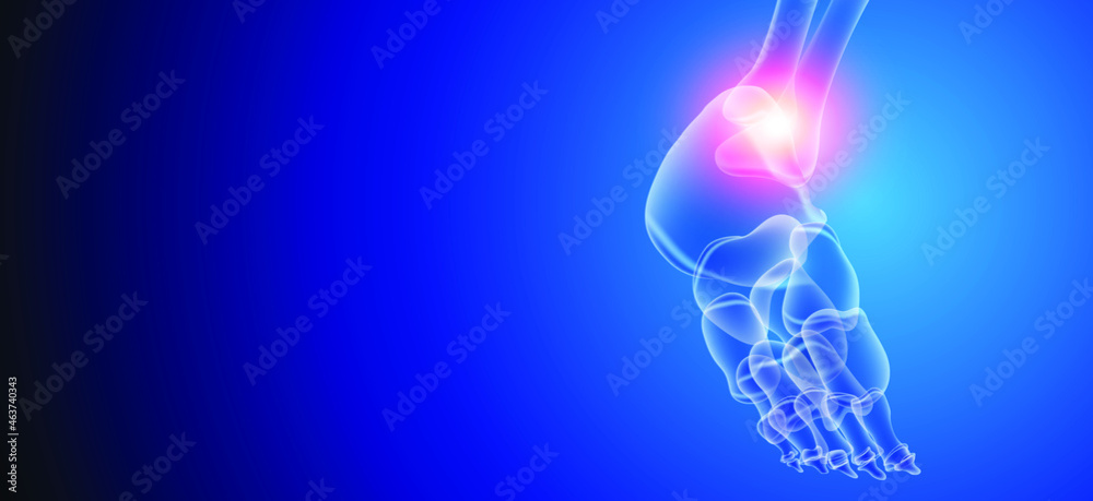 Naklejka premium Illustration of Arthritis ankle joint . Rheumatoid arthritis. Human bone anatomy flat vector illustration on a blue technology background. 3d rendered medically accurate illustration.