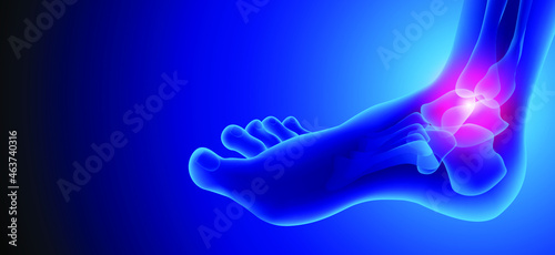 Illustration of Arthritis ankle joint . Rheumatoid arthritis.  Human bone anatomy flat vector illustration on a blue technology background. 3d rendered medically accurate illustration.