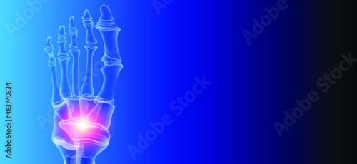 Illustration of Arthritis ankle joint . Rheumatoid arthritis.  Human bone anatomy flat vector illustration on a blue technology background. 3d rendered medically accurate illustration.