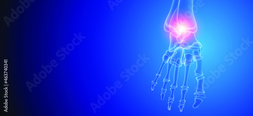 Illustration of Arthritis ankle joint . Rheumatoid arthritis.  Human bone anatomy flat vector illustration on a blue technology background. 3d rendered medically accurate illustration.