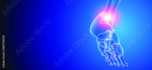 Illustration of Arthritis ankle joint . Rheumatoid arthritis.  Human bone anatomy flat vector illustration on a blue technology background. 3d rendered medically accurate illustration.